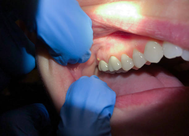 Best Emergency Denture Repair in Norcross, GA